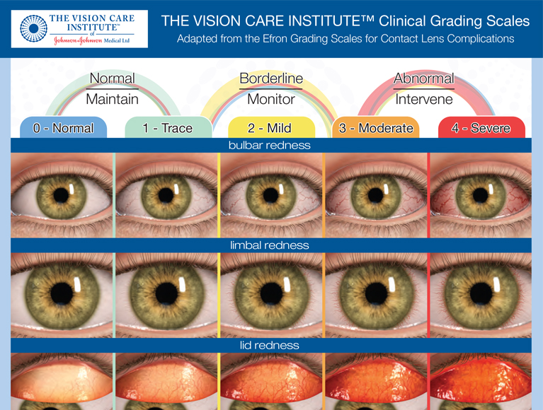 How to manage patients with pterygium