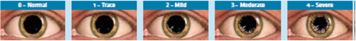 Pterygium grading scales